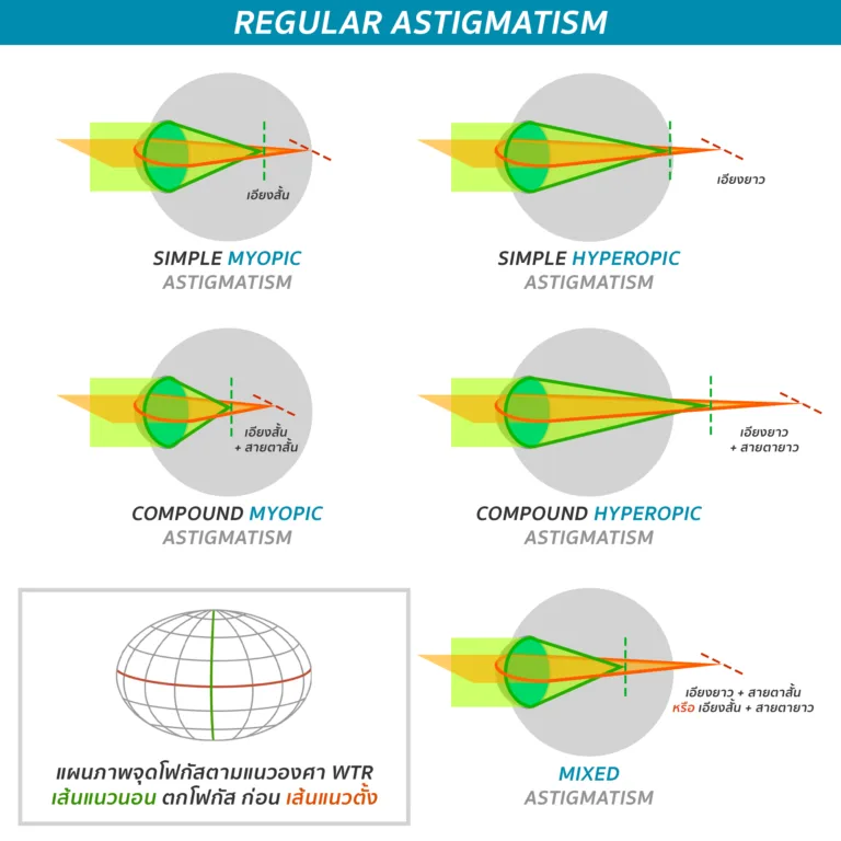 Astigmatism_5-types